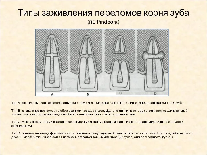 Типы заживления переломов корня зуба (по Pindborg) Тип А: фрагменты тесно сопоставлены