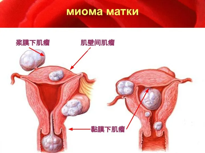 миома матки 肌壁间肌瘤 浆膜下肌瘤 黏膜下肌瘤 Миома под хомовым насосом Миома среди стейк