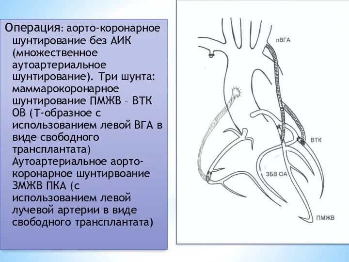 Операция: аорто-коронарное шунтирование без АИК (множественное аутоартериальное шунтирование). Три шунта: маммарокоронарное шунтирование