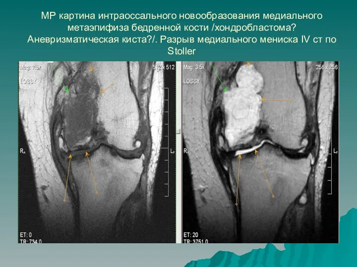 МР картина интраоссального новообразования медиального метаэпифиза бедренной кости /хондробластома? Аневризматическая киста?/. Разрыв