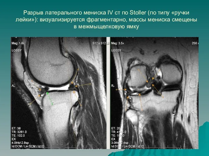 Разрыв латерального мениска IV ст по Stoller (по типу «ручки лейки»): визуализируется