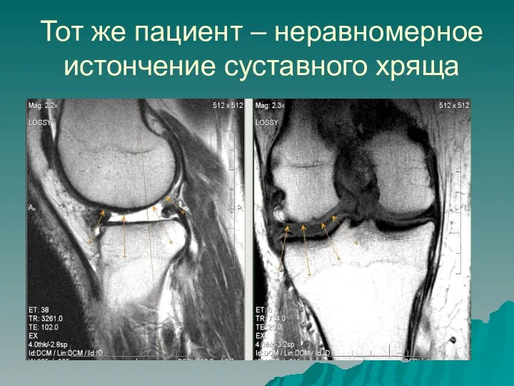 Тот же пациент – неравномерное истончение суставного хряща