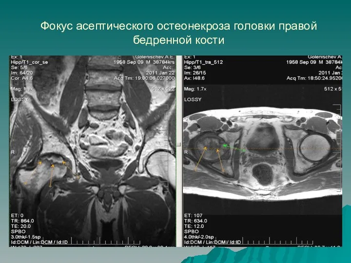 Фокус асептического остеонекроза головки правой бедренной кости