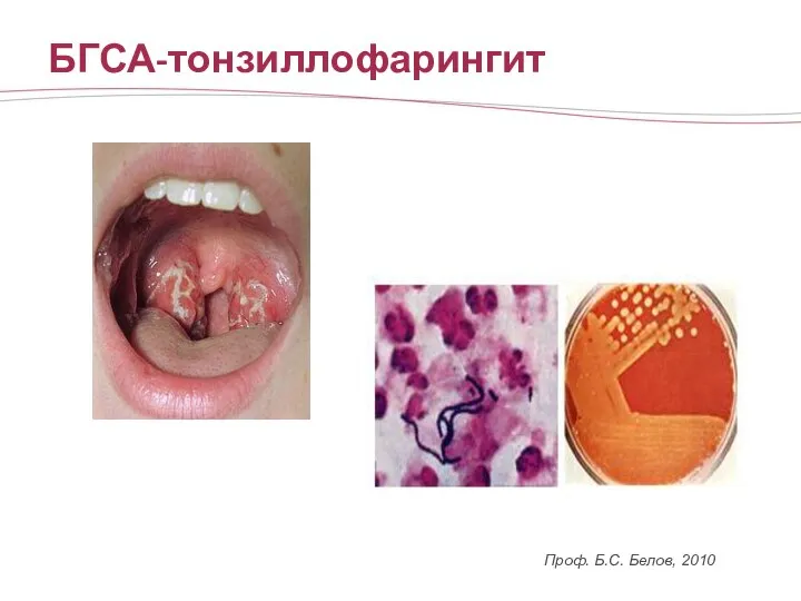 БГСА-тонзиллофарингит Проф. Б.С. Белов, 2010