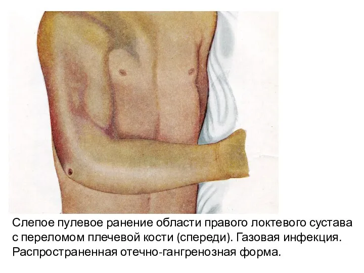 Слепое пулевое ранение области правого локтевого сустава с переломом плечевой кости (спереди).