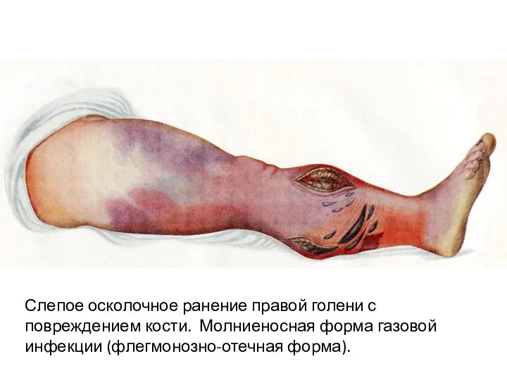 Слепое осколочное ранение правой голени с повреждением кости. Молниеносная форма газовой инфекции (флегмонозно-отечная форма).
