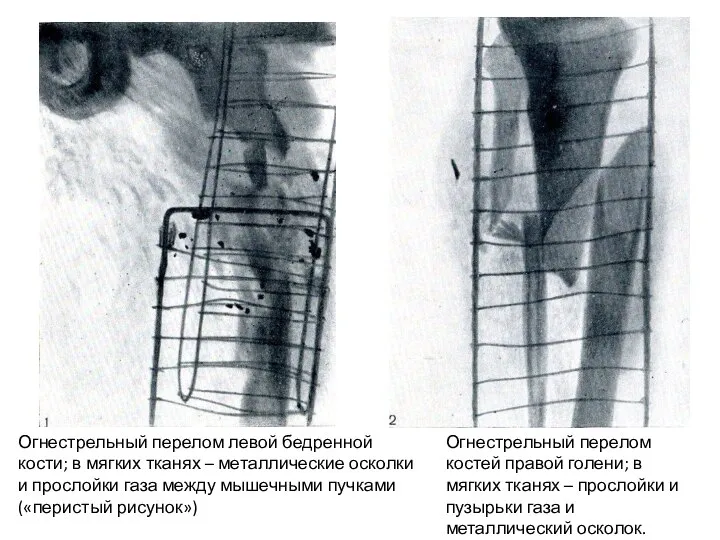 Огнестрельный перелом левой бедренной кости; в мягких тканях – металлические осколки и