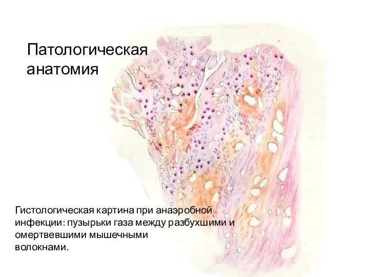 Гистологическая картина при анаэробной инфекции: пузырьки газа между разбухшими и омертвевшими мышечными волокнами. Патологическая анатомия