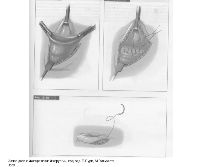 Атлас детской оперативной хирургии; под ред. П.Пури, М.Гольварта; 2009