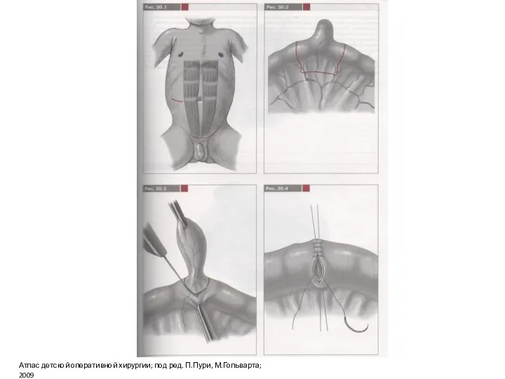 Атлас детской оперативной хирургии; под ред. П.Пури, М.Гольварта; 2009