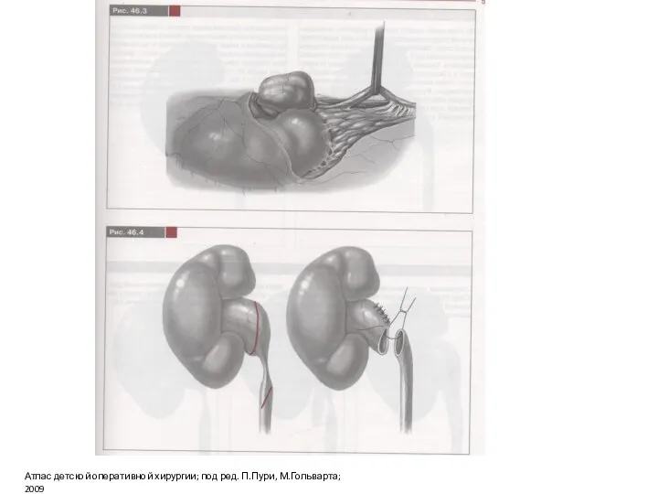 Атлас детской оперативной хирургии; под ред. П.Пури, М.Гольварта; 2009
