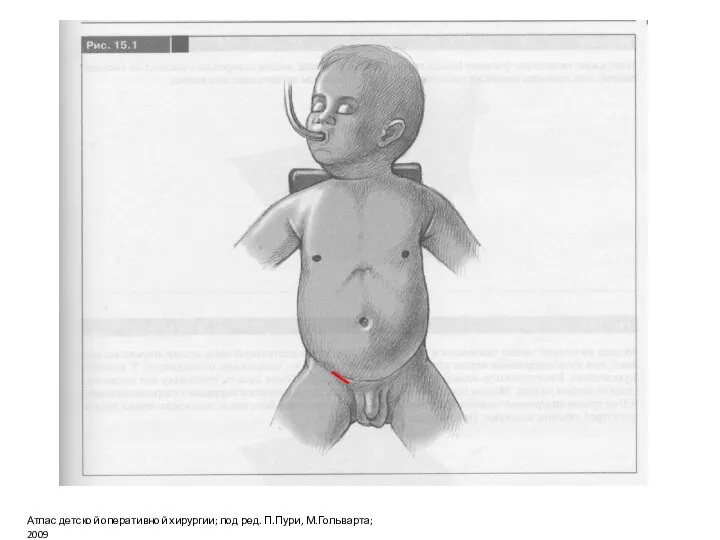Атлас детской оперативной хирургии; под ред. П.Пури, М.Гольварта; 2009