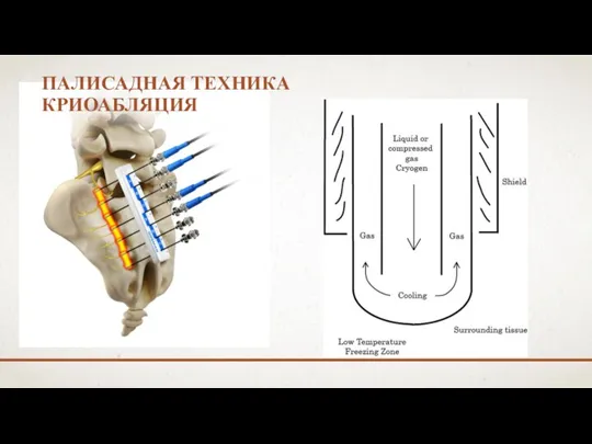 ПАЛИСАДНАЯ ТЕХНИКА КРИОАБЛЯЦИЯ