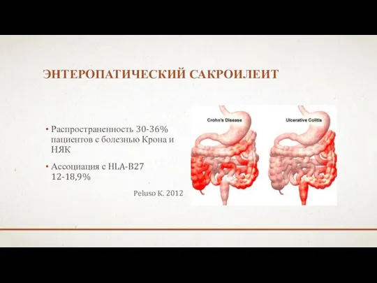 ЭНТЕРОПАТИЧЕСКИЙ САКРОИЛЕИТ Распространенность 30-36% пациентов с болезнью Крона и НЯК Ассоциация с