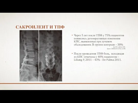 САКРОИЛЕИТ И ТПФ Через 5 лет после ТПФ у 75% пациентов появились