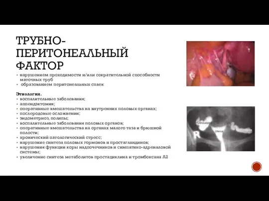 ТРУБНО-ПЕРИТОНЕАЛЬНЫЙ ФАКТОР нарушением проходимости и/или сократительной способности маточных труб образованием перитонеальных спаек