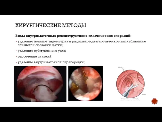 ХИРУРГИЧЕСКИЕ МЕТОДЫ Виды внутриматочных реконструктивно-пластических операций: удаление полипов эндометрия и раздельное диагностическое