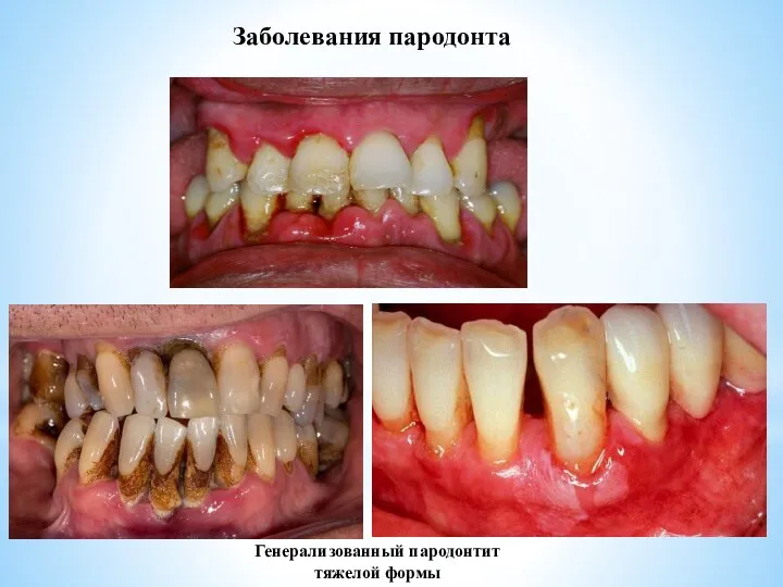 Заболевания пародонта Генерализованный пародонтит тяжелой формы