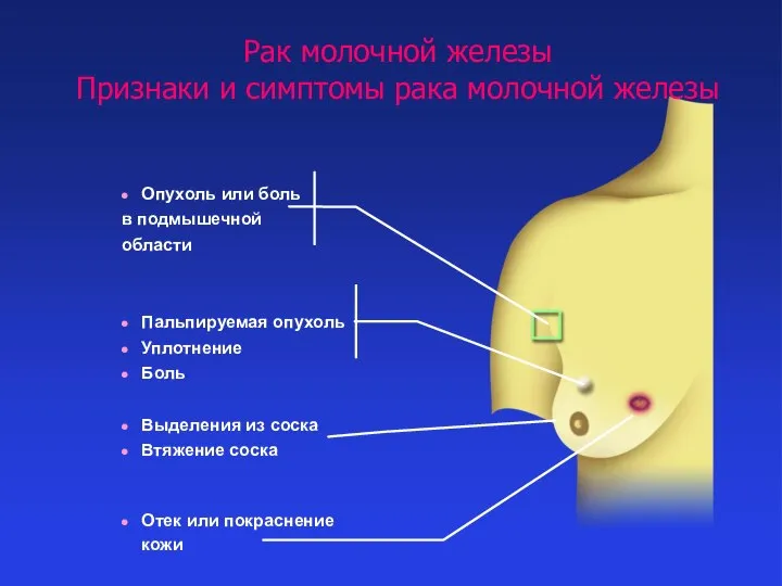 ВМедА 2014 г. Рак молочной железы Признаки и симптомы рака молочной железы