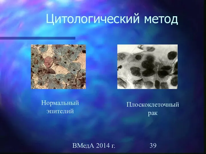 ВМедА 2014 г. Цитологический метод Плоскоклеточный рак Нормальный эпителий