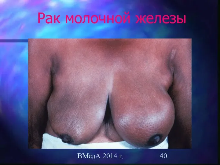ВМедА 2014 г. Рак молочной железы