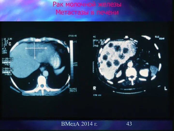 ВМедА 2014 г. Рак молочной железы Метастазы в печени