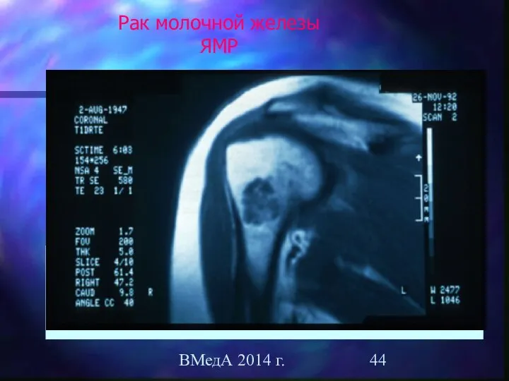 ВМедА 2014 г. Рак молочной железы ЯМР