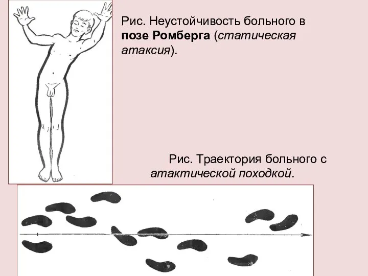 Рис. Неустойчивость больного в позе Ромберга (статическая атаксия). Рис. Траектория больного с атактической походкой.