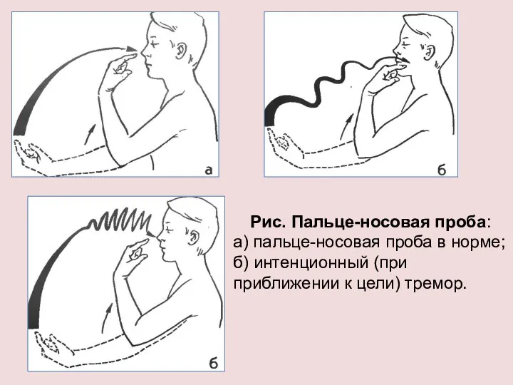 Рис. Пальце-носовая проба: а) пальце-носовая проба в норме; б) интенционный (при приближении к цели) тремор.