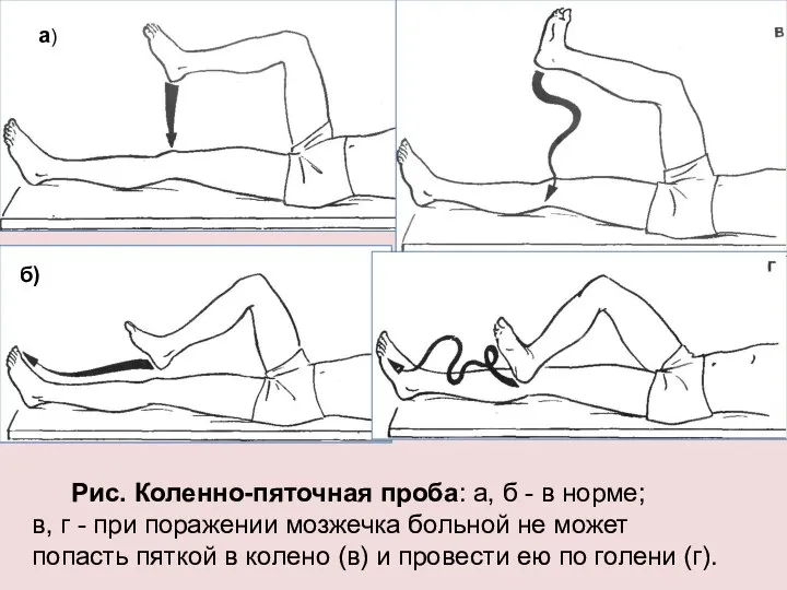 Рис. Коленно-пяточная проба: а, б - в норме; в, г - при