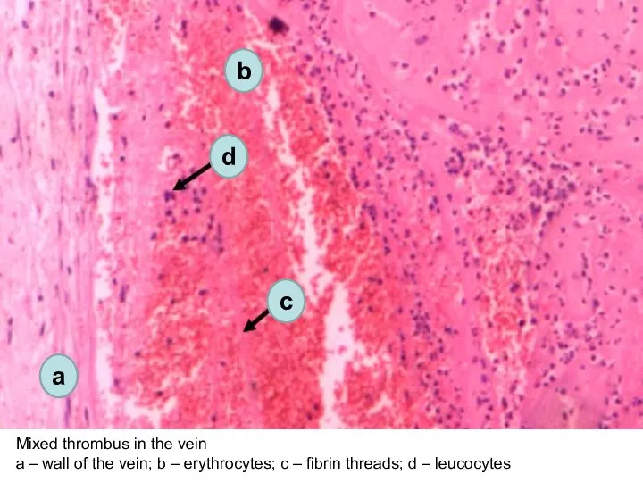 Mixed thrombus in the vein а – wall of the vein; b