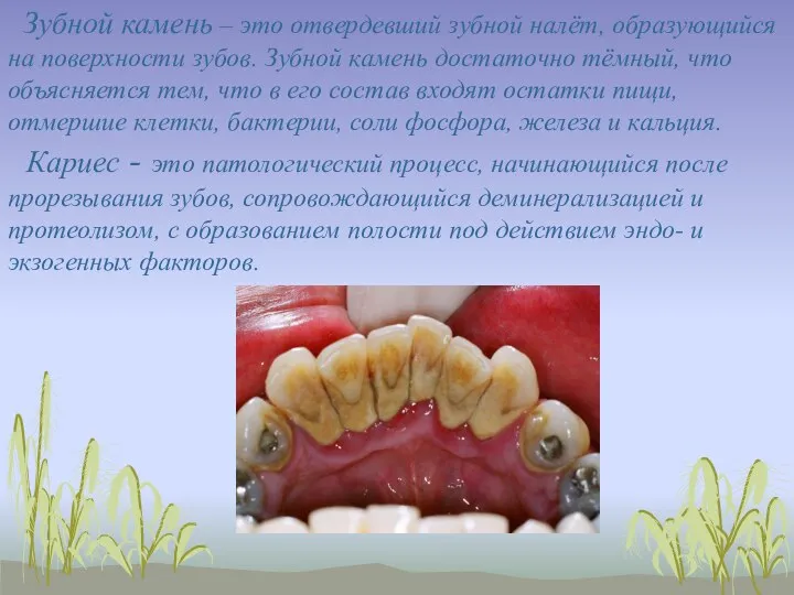 Зубной камень – это отвердевший зубной налёт, образующийся на поверхности зубов. Зубной