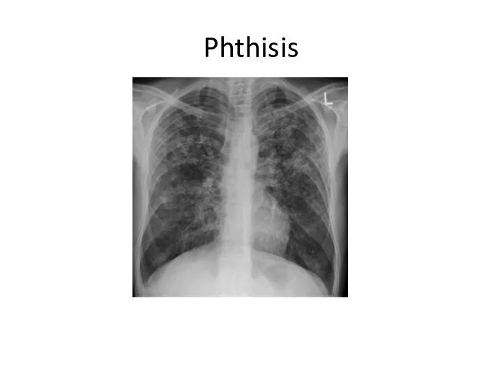 Phthisis