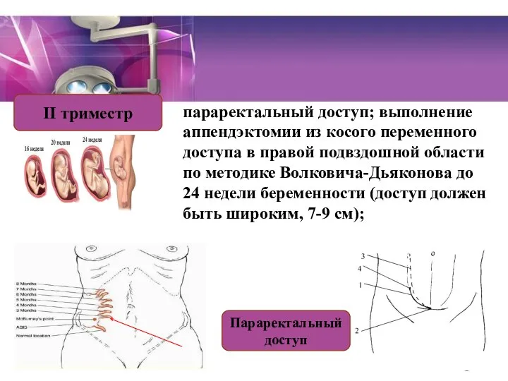 параректальный доступ; выполнение аппендэктомии из косого переменного доступа в правой подвздошной области