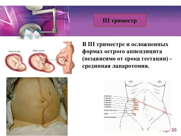 ІІІ триместр В ІІІ триместре и осложненных формах острого аппендицита (независимо от