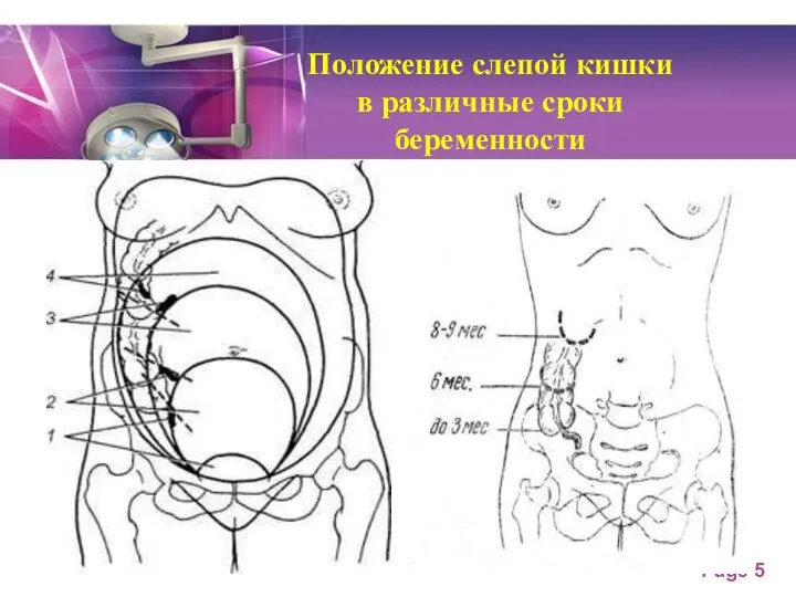 Положение слепой кишки в различные сроки беременности