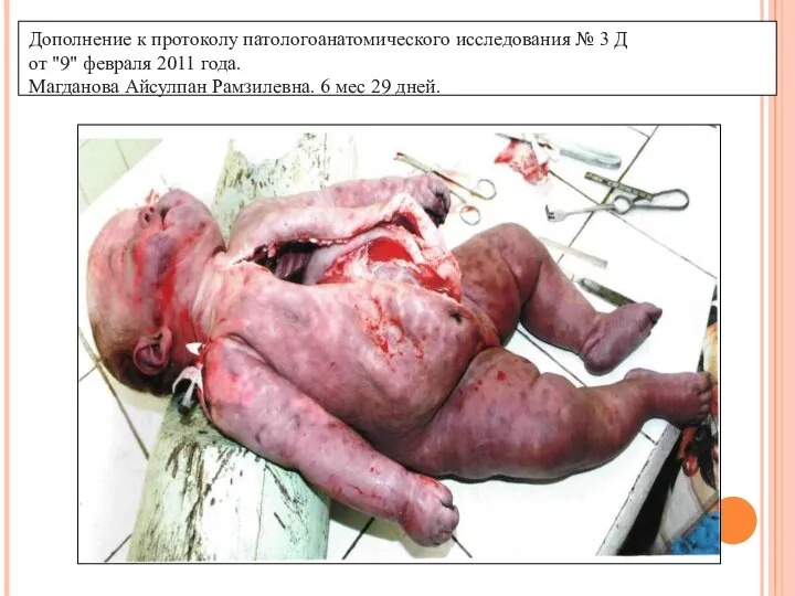 Дополнение к протоколу патологоанатомического исследования № 3 Д от "9" февраля 2011