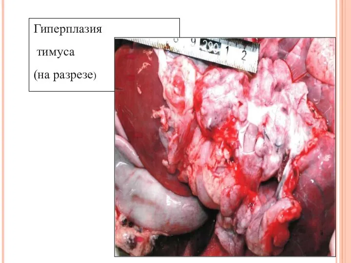Гиперплазия тимуса (на разрезе)