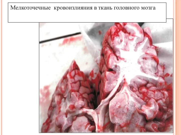 Мелкоточечные кровоизлияния в ткань головного мозга