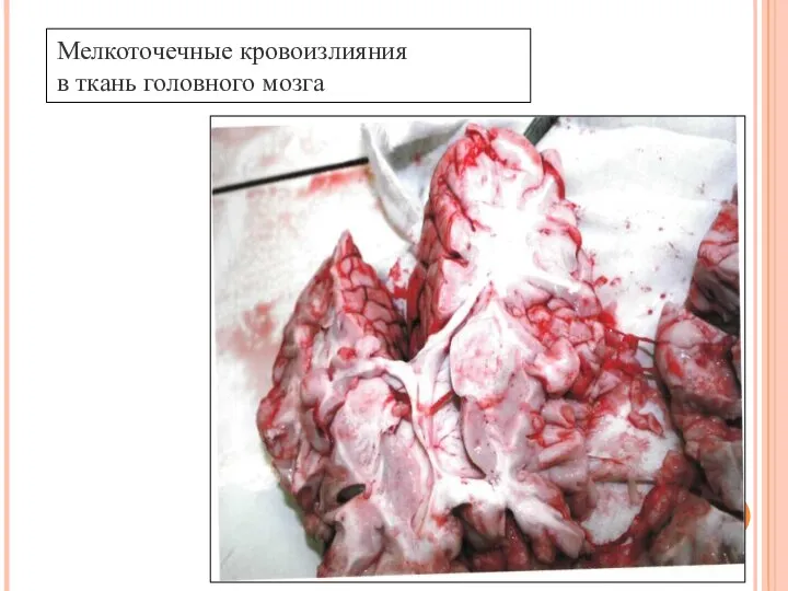 Мелкоточечные кровоизлияния в ткань головного мозга