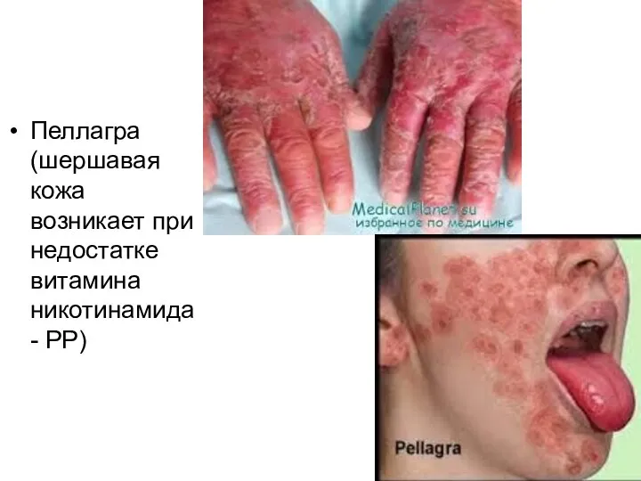 Пеллагра (шершавая кожа возникает при недостатке витамина никотинамида - РР)