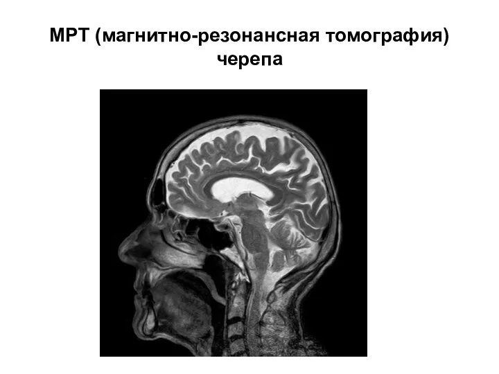 МРТ (магнитно-резонансная томография) черепа