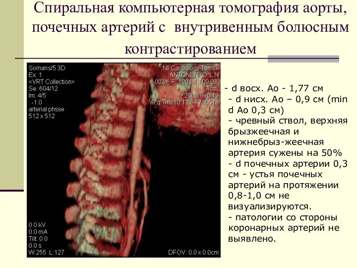 Спиральная компьютерная томография аорты, почечных артерий с внутривенным болюсным контрастированием d восх.