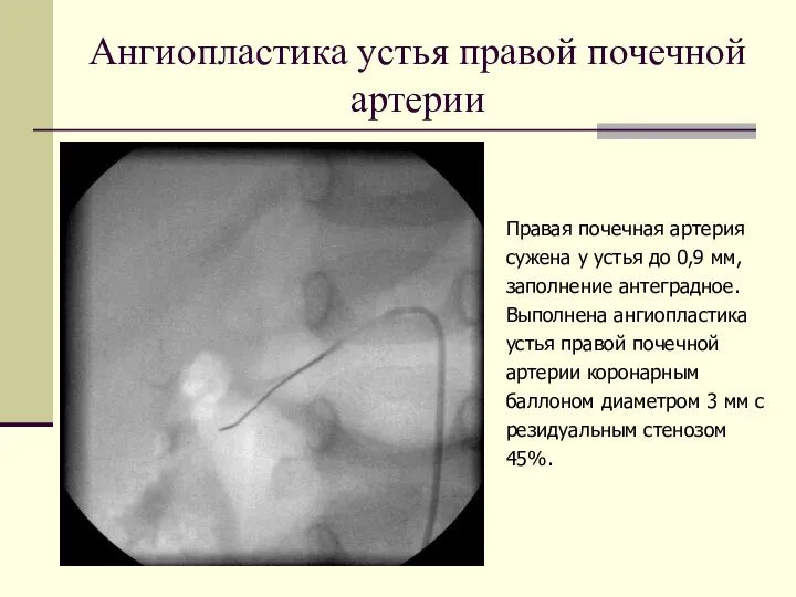 Ангиопластика устья правой почечной артерии Правая почечная артерия сужена у устья до