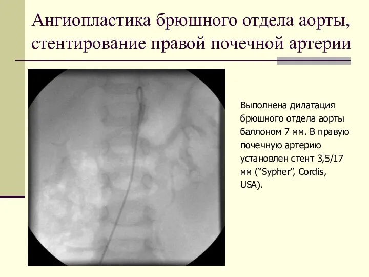 Ангиопластика брюшного отдела аорты, стентирование правой почечной артерии Выполнена дилатация брюшного отдела