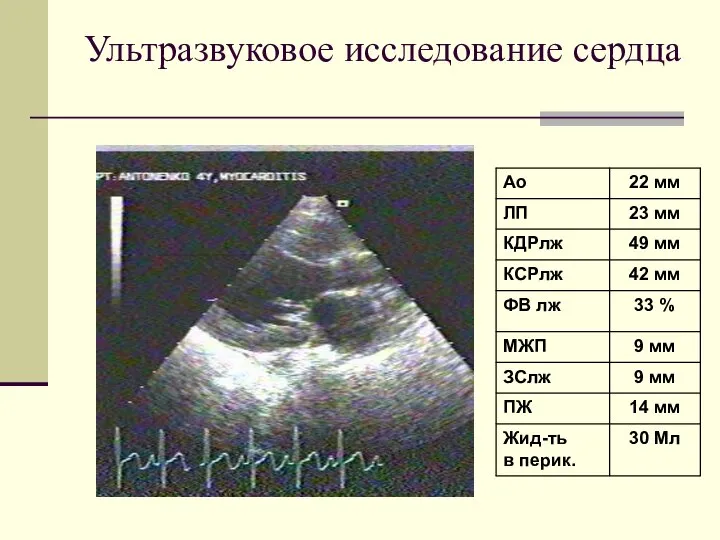 Ультразвуковое исследование сердца