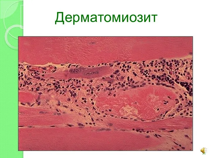 Дерматомиозит