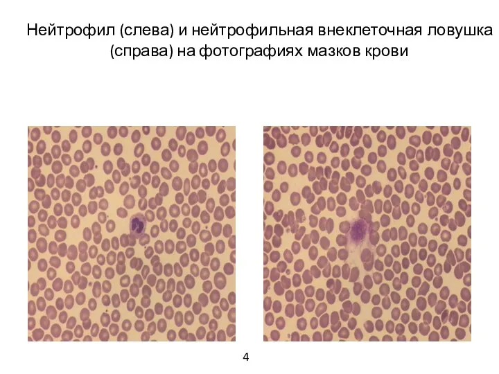 Нейтрофил (слева) и нейтрофильная внеклеточная ловушка (справа) на фотографиях мазков крови 4