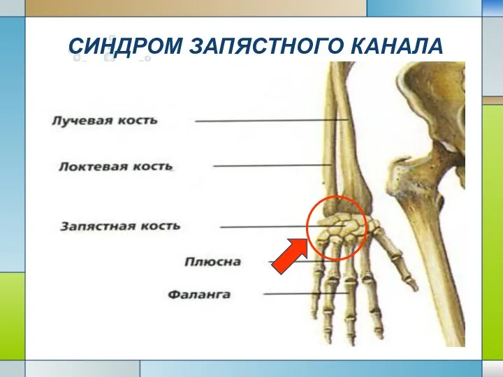 СИНДРОМ ЗАПЯСТНОГО КАНАЛА