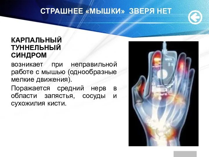 СТРАШНЕЕ «МЫШКИ» ЗВЕРЯ НЕТ КАРПАЛЬНЫЙ ТУННЕЛЬНЫЙ СИНДРОМ возникает при неправильной работе с